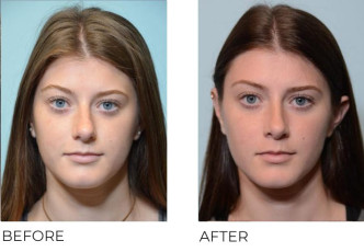 19 year old female who underwent Rhinoplasty- Preop 6.26.16, postop 1.9.17