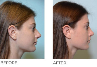 19 year old female who underwent Rhinoplasty- Preop 6.26.16, postop 1.9.17