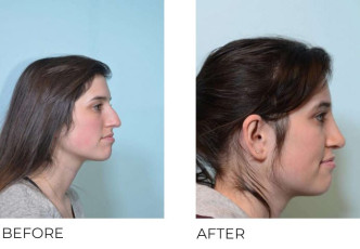 23 year old female who underwent Rhinoplasty- Preop 8.14.17, postop 1.3.18