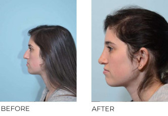 23 year old female who underwent Rhinoplasty- Preop 8.14.17, postop 1.3.18