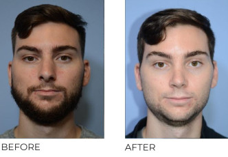 24 year old male who underwent Rhinoplasty – Preop 7.8.20, Postop 9.14.20