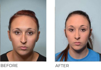 24 year old female who underwent Rhinoplasty- Preop 9.19.16, postop 5.3.17