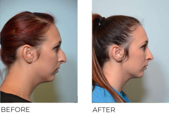 24 year old female who underwent Rhinoplasty- Preop 9.19.16, postop 5.3.17