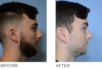 24 year old male who underwent Rhinoplasty – Preop 7.8.20, Postop 9.14.20