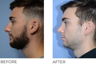 24 year old male who underwent Rhinoplasty – Preop 7.8.20, Postop 9.14.20