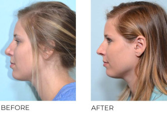 25 year old female who underwent Rhinoplasty- Preop 7.12.17, Postop 8.16.17