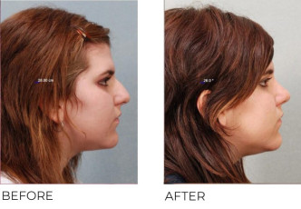 25 year old female who underwent Rhinoplasty- Preop 12.17.07, postop 11.5.08