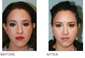 25-35 Year Old Woman Treated with Rhinoplasty 1 year Post-Op