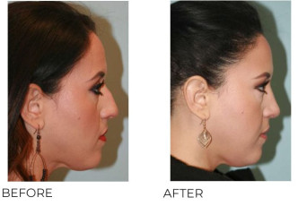 25-35 Year Old Woman Treated with Rhinoplasty 1 year Post-Op