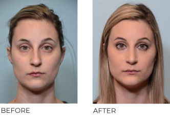 27 year old female who underwent Rhinoplasty with Chin Implant- Preop 3.22.17, postop 4.19.17