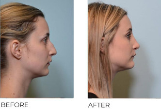 27 year old female who underwent Rhinoplasty with Chin Implant- Preop 3.22.17, postop 4.19.17