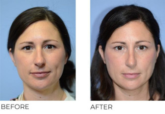 40 year old female who underwent Rhinoplasty – Preop 6.1.20, Postop 10.14.20