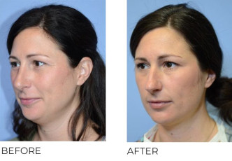 40 year old female who underwent Rhinoplasty – Preop 6.1.20, Postop 10.14.20