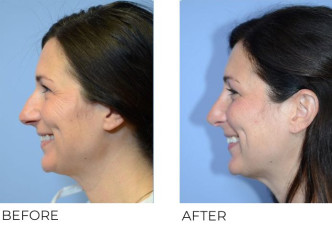 40 year old female who underwent Rhinoplasty – Preop 6.1.20, Postop 10.14.20