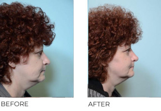 49 year old female who underwent Rhinoplasty- Preop 3.27.17, postop 5.15.17