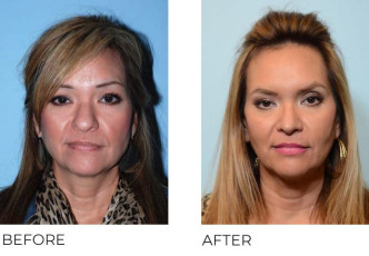 52 year old female who underwent Rhinoplasty- Preop 2.6.13, Postop 4.17.17