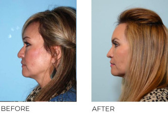 52 year old female who underwent Rhinoplasty- Preop 2.6.13, Postop 4.17.17