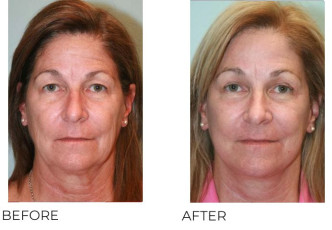 55-64 Year Old Woman Treated with Facelift, Endoscopic Brow Lifting and Blepharopasty 6 months Post-Op