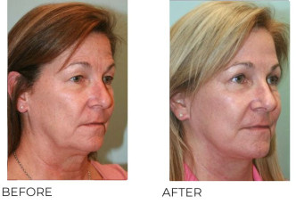 55-64 Year Old Woman Treated with Facelift, Endoscopic Brow Lifting and Blepharopasty 6 months Post-Op