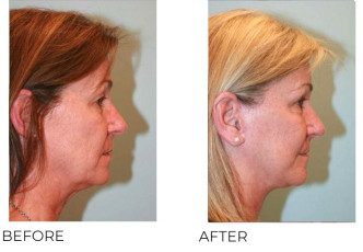 55-64 Year Old Woman Treated with Facelift, Endoscopic Brow Lifting and Blepharopasty 6 months Post-Op