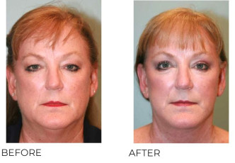 55-64 Year Old Woman Treated with Facelift, Endoscopic Brow Lifting and Blepharopasty 6 months Post-Op