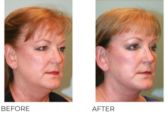 55-64 Year Old Woman Treated with Facelift, Endoscopic Brow Lifting and Blepharopasty 6 months Post-Op