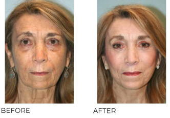 65-74 Year Old Woman Treated with Facelift, Endosopic Brow Lifting, Blepharoplasty, and Chin Implant 6 months Post-Op