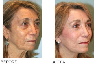 65-74 Year Old Woman Treated with Facelift, Endosopic Brow Lifting, Blepharoplasty, and Chin Implant 6 months Post-Op