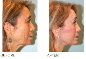 65-74 Year Old Woman Treated with Facelift, Endosopic Brow Lifting, Blepharoplasty, and Chin Implant 6 months Post-Op