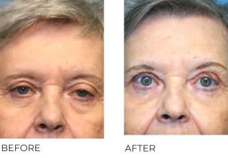75-84 Year Old Woman Treated with Ptosis Repair 1 Month Post -Op