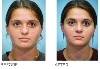 17 Year Old Woman Treated With Rhinoplasty 1 Month Post-Op