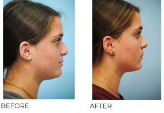 17 Year Old Woman Treated With Rhinoplasty 1 Month Post-Op