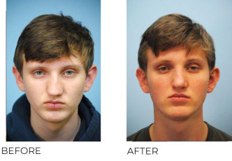 17 Year Old Man Treated with Rhinoplasty 1 Year Post-Op