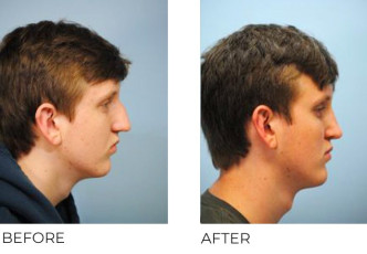 17 Year Old Man Treated with Rhinoplasty 1 Year Post-Op