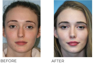 18-25 Year Old Woman Treated With Rhinoplasty 6 Months Post-Op