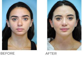 18-24 Year Old Woman Treated With Rhinoplasty 1 Year Post-Op
