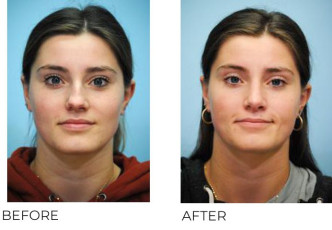 18-25 Year Old Woman Treated With Rhinoplasty 4 Months Post-Op