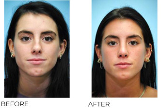 18-25 Year Old Woman Treated With Rhinoplasty 7 Months Post-Op