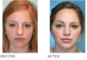 18-25 Year Old Woman Treated With Rhinoplasty 3 Years Post-Op