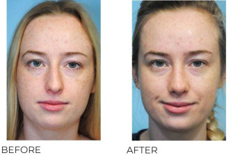 18-24 Year Old Woman Treated With Rhinoplasty 1 Year Post-Op