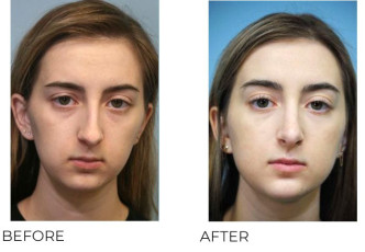 18-24 Year Old Woman Treated With Rhinoplasty 1 Year Post-Op