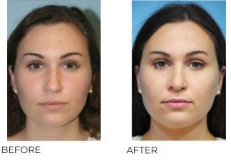 18-24 Year Old Woman Treated With Rhinoplasty 1 Year Post-Op