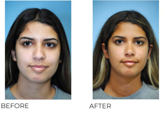 18-24 Year Old Woman Treated With Rhinoplasty 9 Months Post-Op