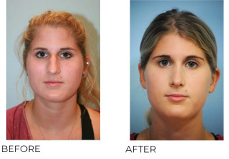 18-24 Year Old Woman Treated With Rhinoplasty 4 Years Post-Op