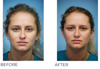 18-24 Year Old Woman Treated With Rhinoplasty 2 Months Post-Op