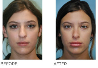 18-24 Year Old Woman Treated with Rhinoplasty 1 Year Post-Op