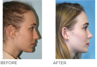18-25 Year Old Woman Treated With Rhinoplasty 6 Months Post-Op