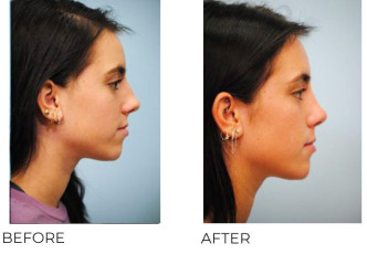 18-25 Year Old Woman Treated With Rhinoplasty 7 Months Post-Op