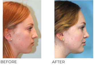 18-25 Year Old Woman Treated With Rhinoplasty 3 Years Post-Op