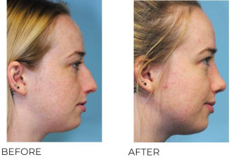 18-24 Year Old Woman Treated With Rhinoplasty 1 Year Post-Op